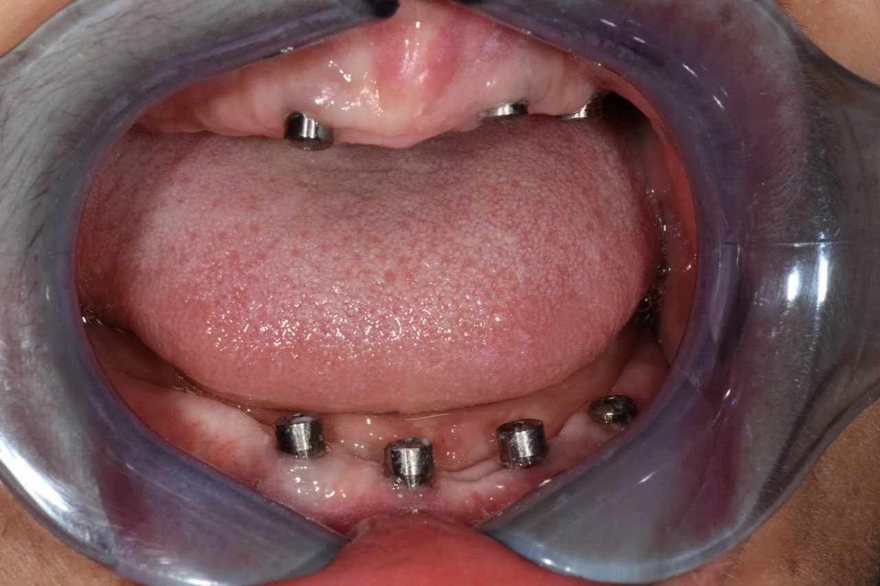 Імпланти та абатменти