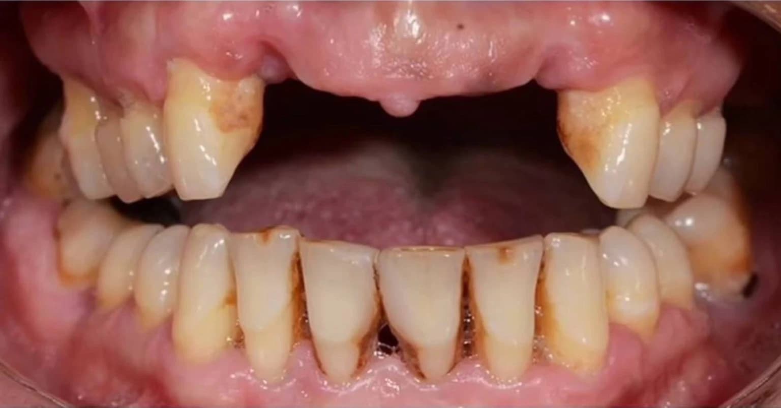До лікування — відсутність зубів