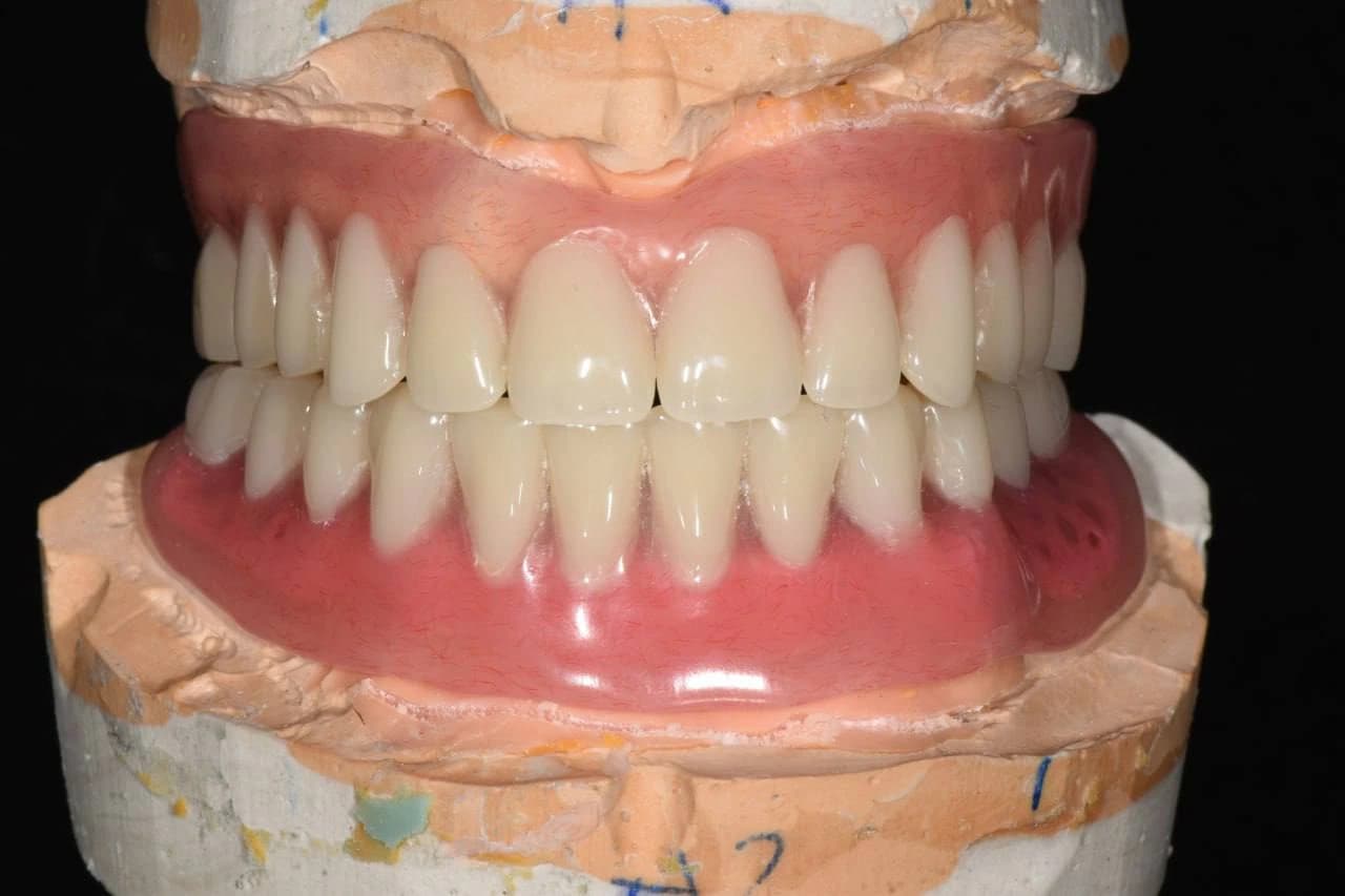 Готовий повнощелепний протез