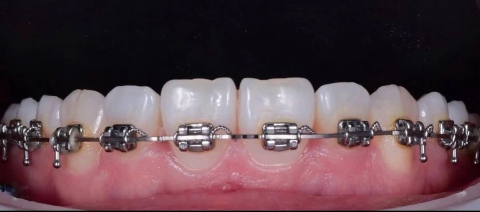 Після лікування брекетами