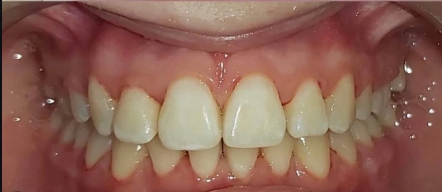 Після лікування брекетами