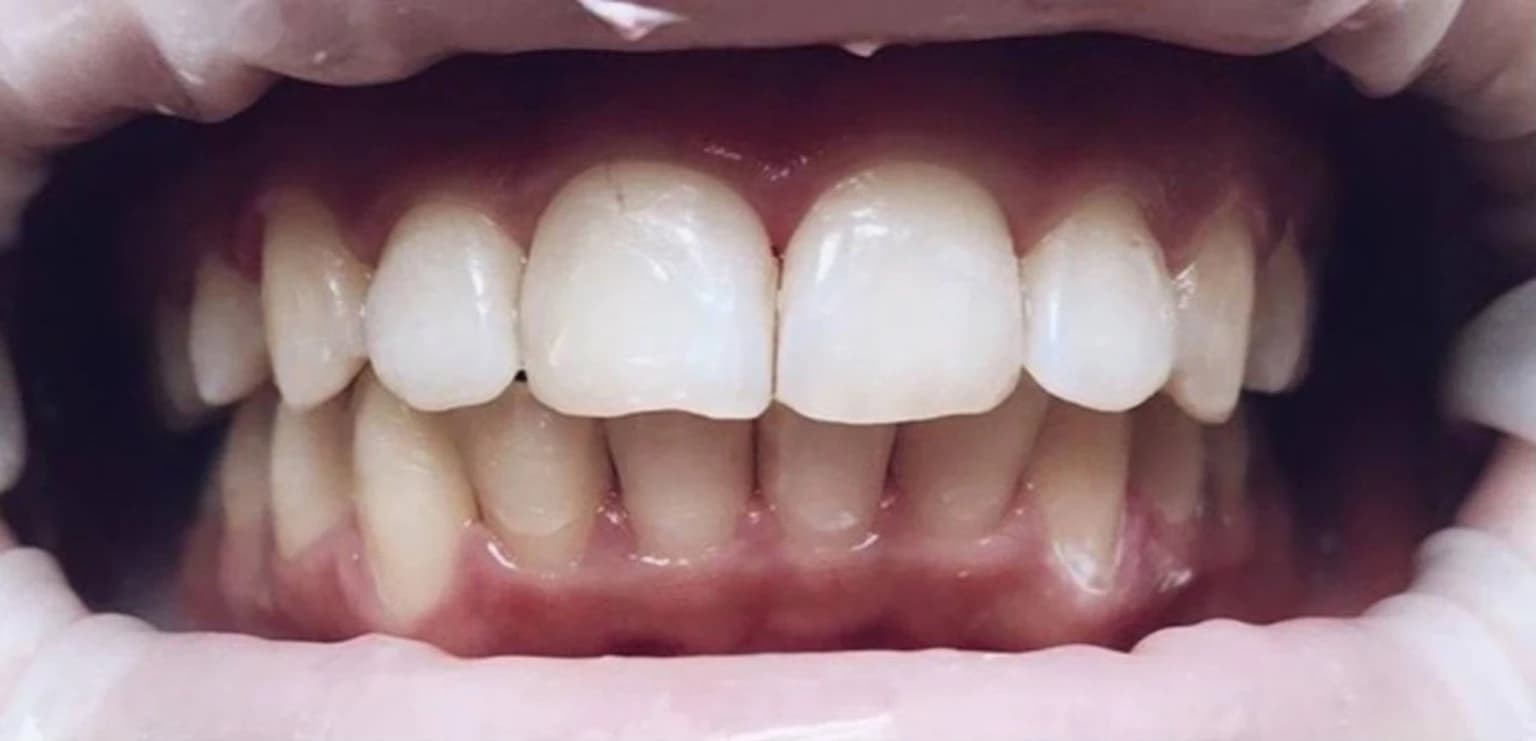 Після лікування брекетами