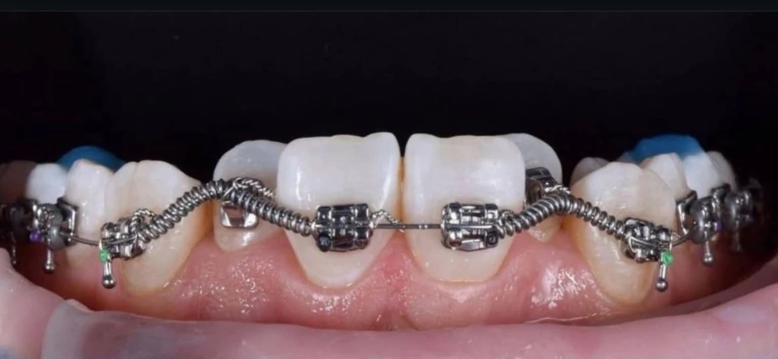 До лікування брекетами