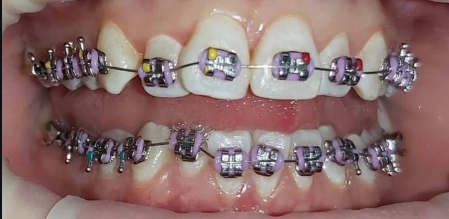 До лікування брекетами