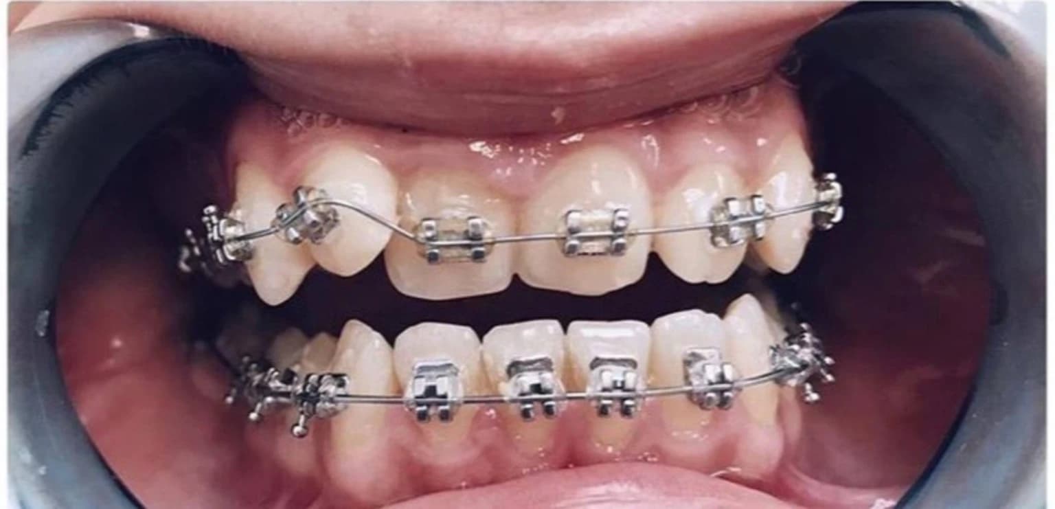 До лікування брекетами