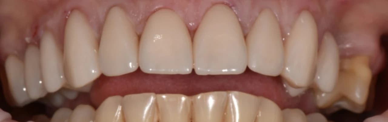 Вініри — результат після встановлення, клінічний випадок після лікування