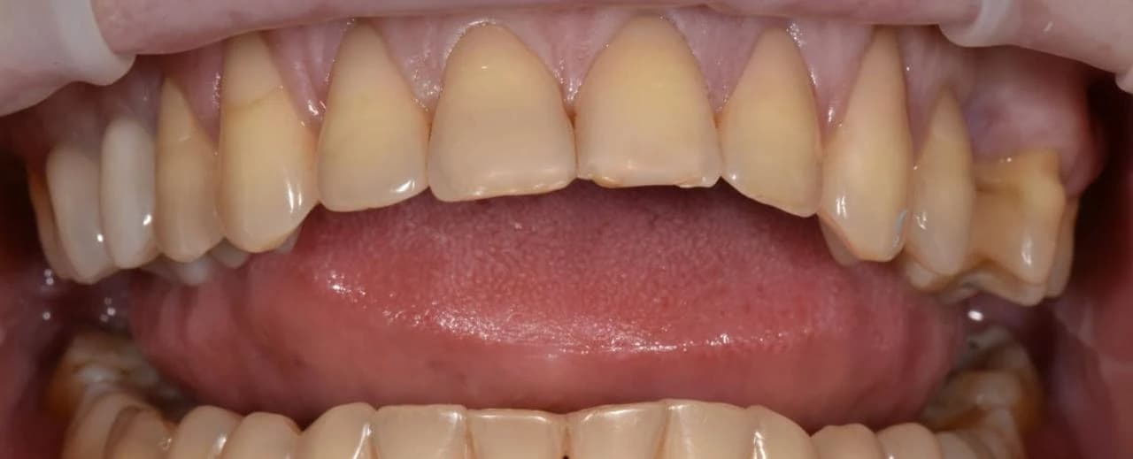 Вініри — клінічний стан зубів до встановлення, фото до лікування