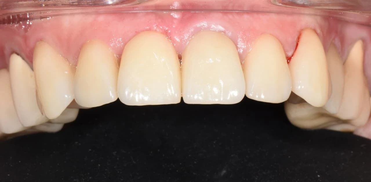 Вініри — результат після встановлення, клінічний випадок після лікування