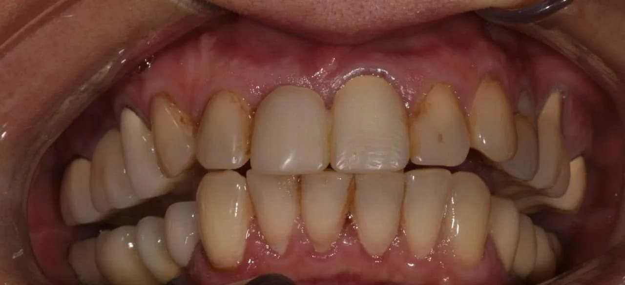 Вініри — клінічний стан зубів до встановлення, фото до лікування