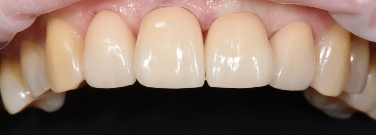 Вініри — результат після встановлення, клінічний випадок після лікування