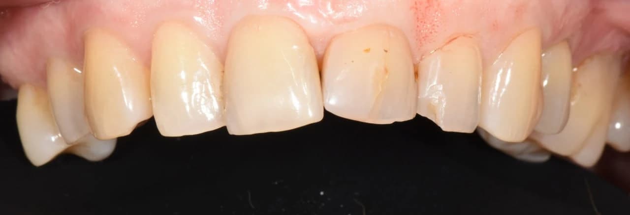 Вініри — клінічний стан зубів до встановлення, фото до лікування
