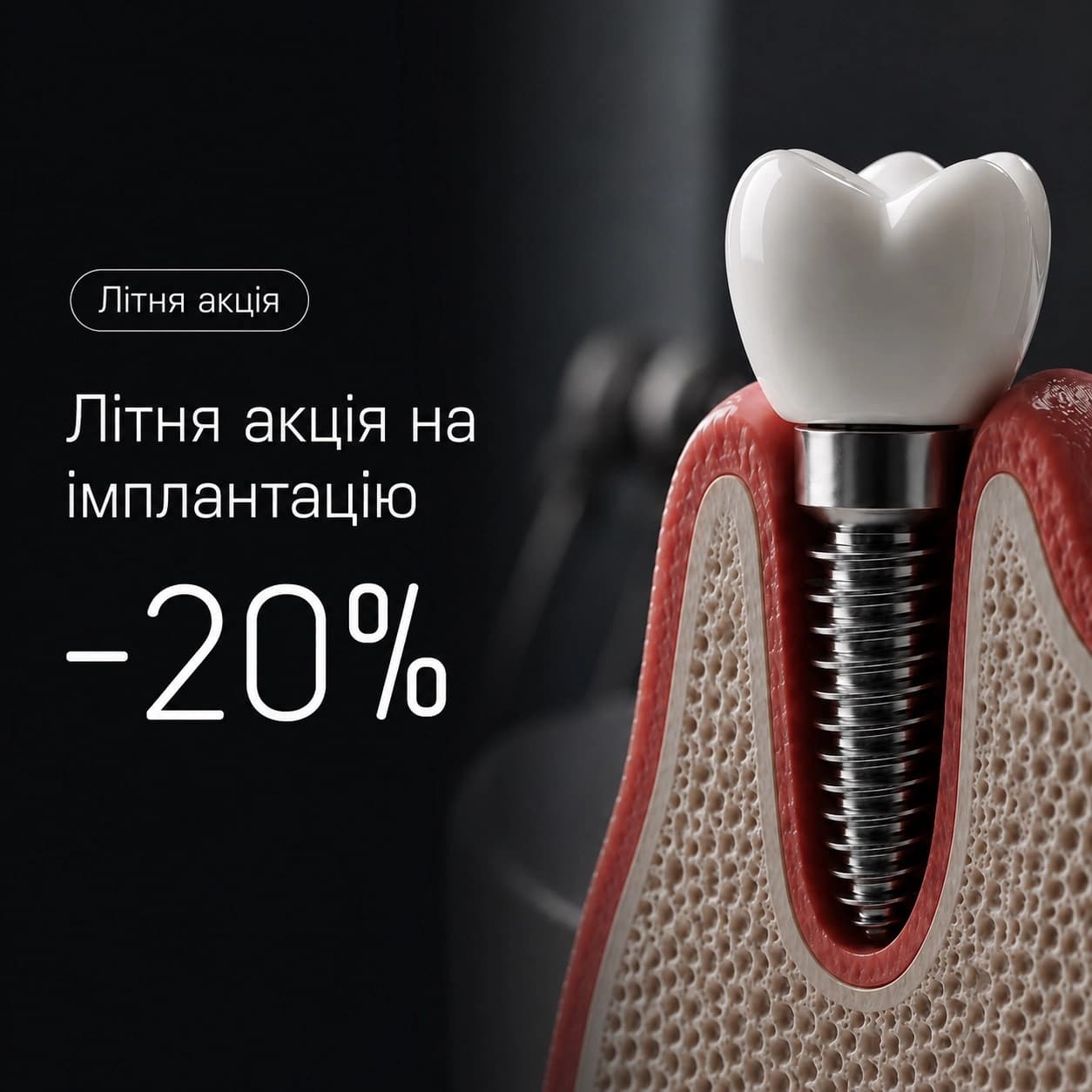 Літня акція на імплантацію −20%