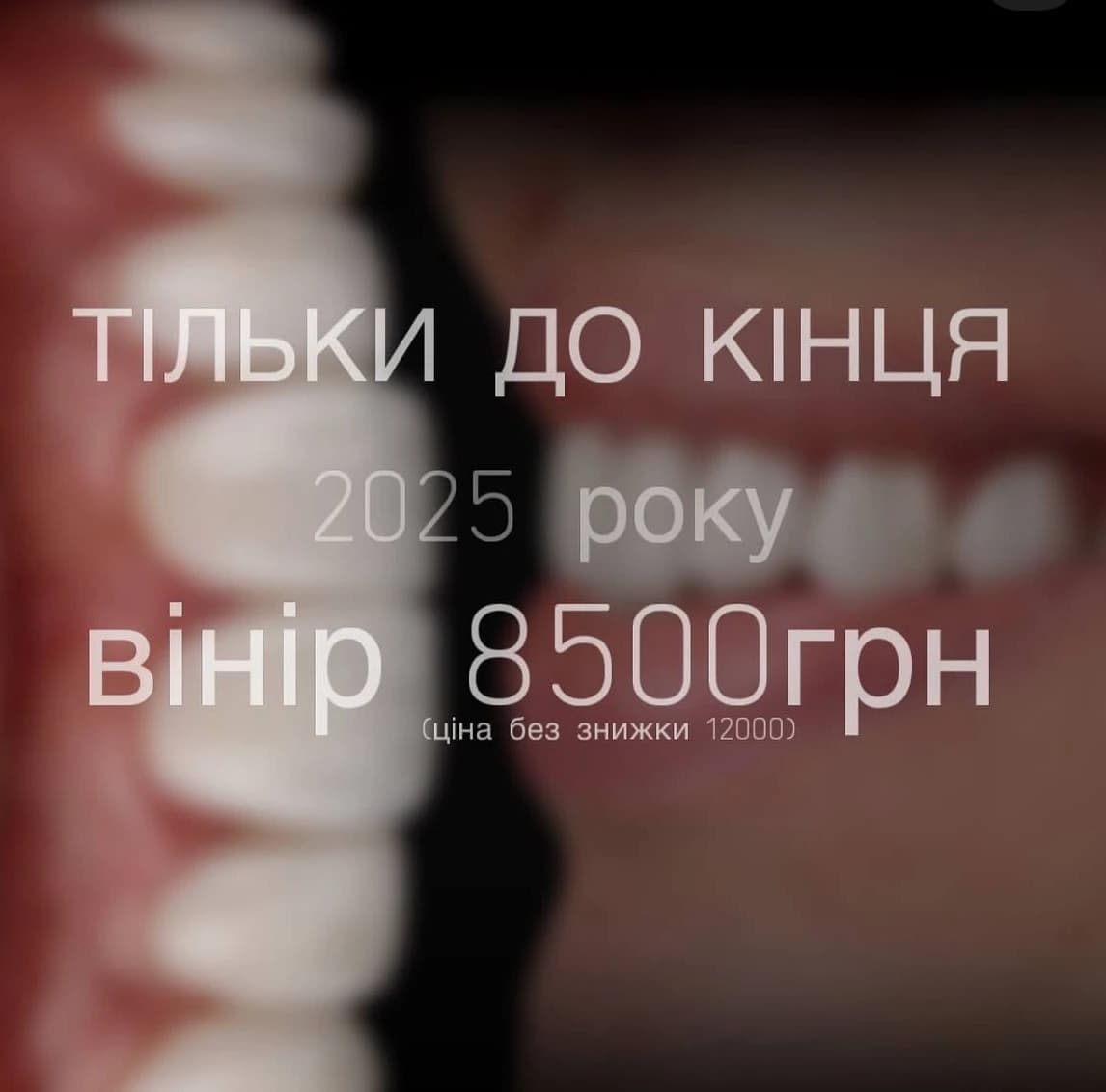 Вініри за фіксованою ціною