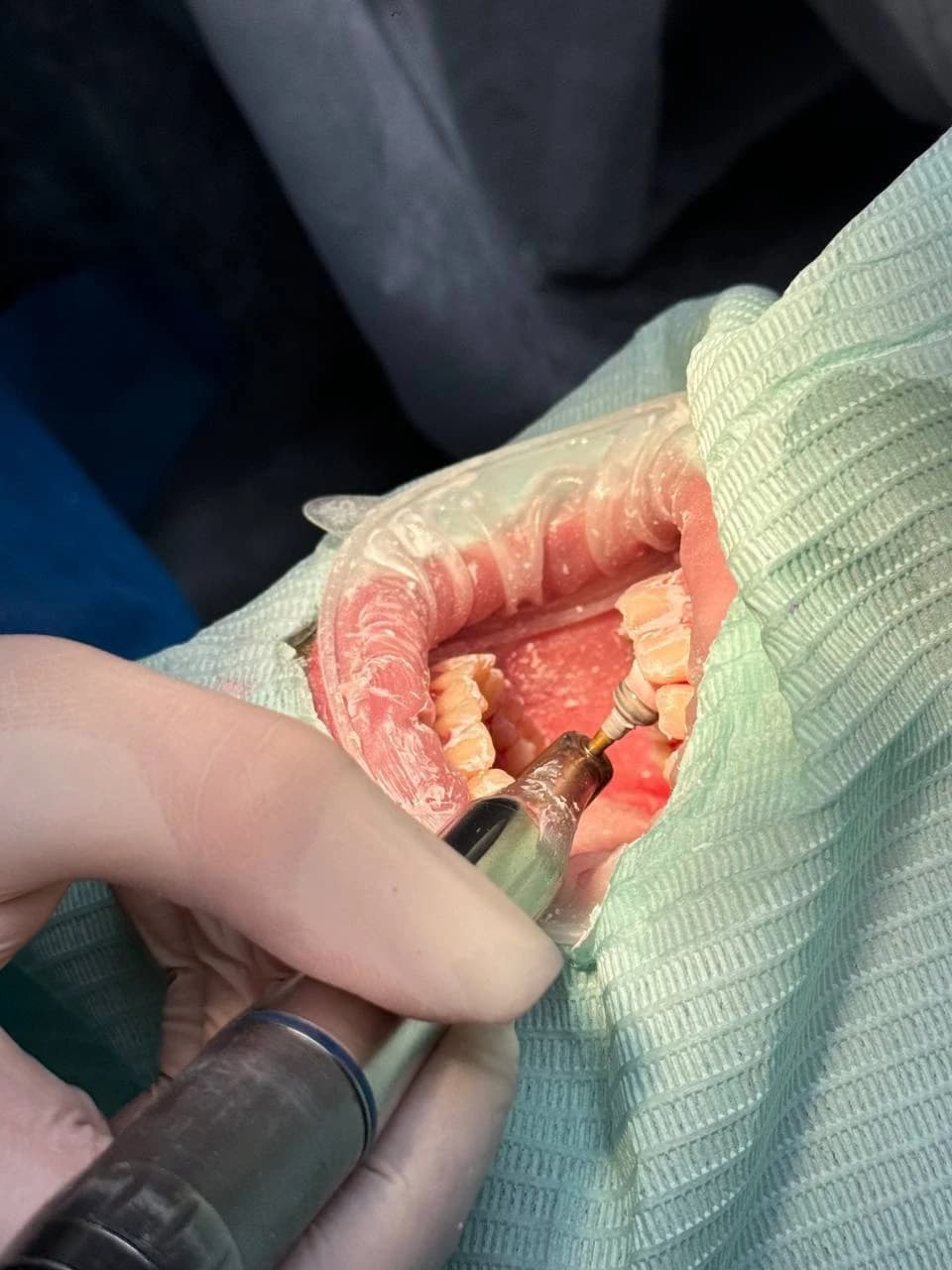 Полірування зубів після професійної чистки