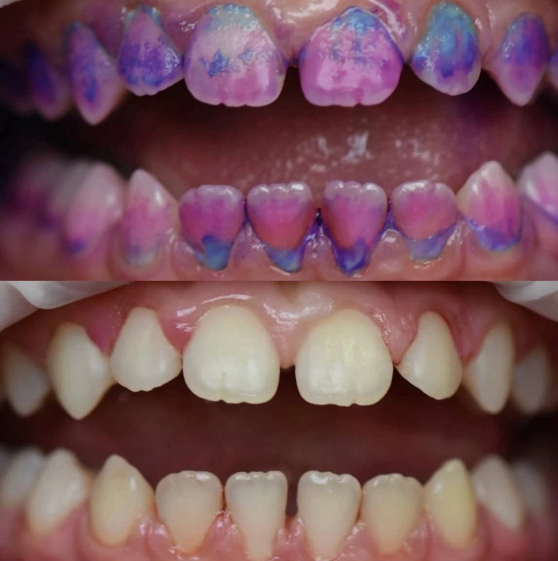 Індикатор зубного нальоту, який показує ділянки нальоту на зубах