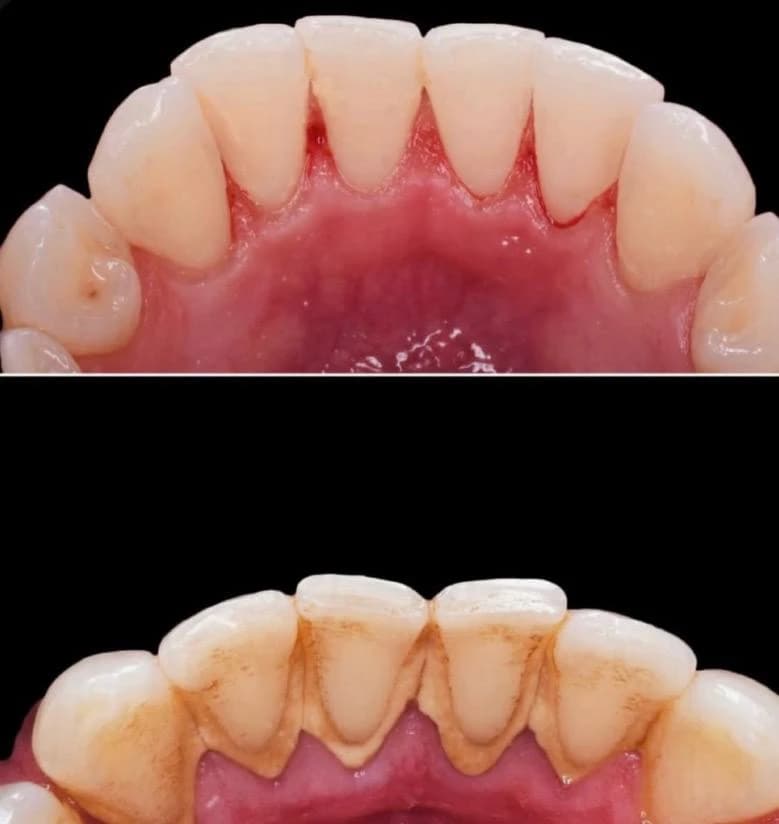 Зубний камінь до та після професійної гігієни зубів