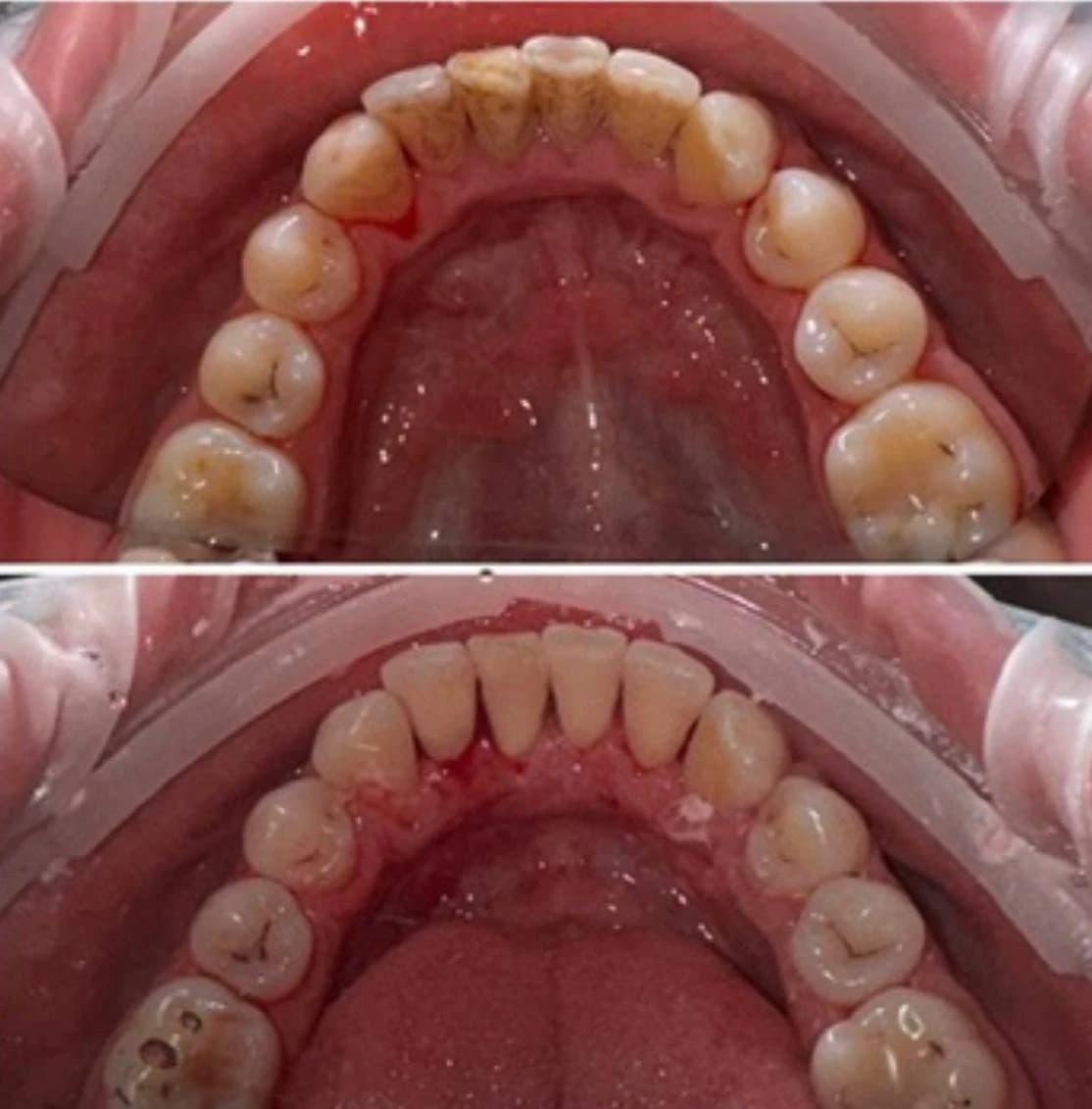 Результат після професійної гігієни зубів
