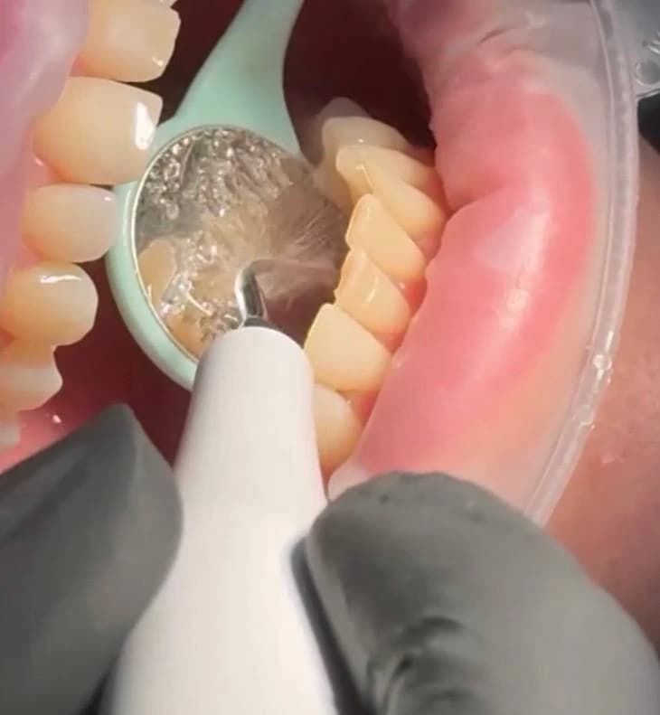 Ультразвукове видалення зубного каменю скейлером