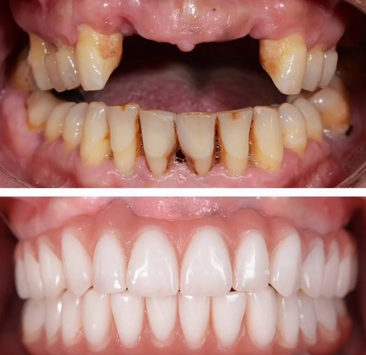 Імплантація зубів — етапи лікування
