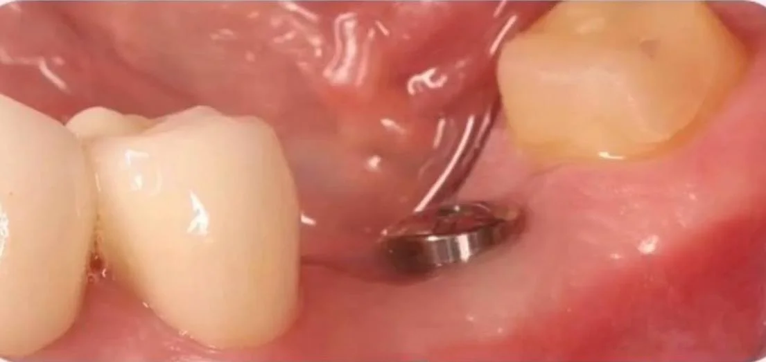 Імплантація