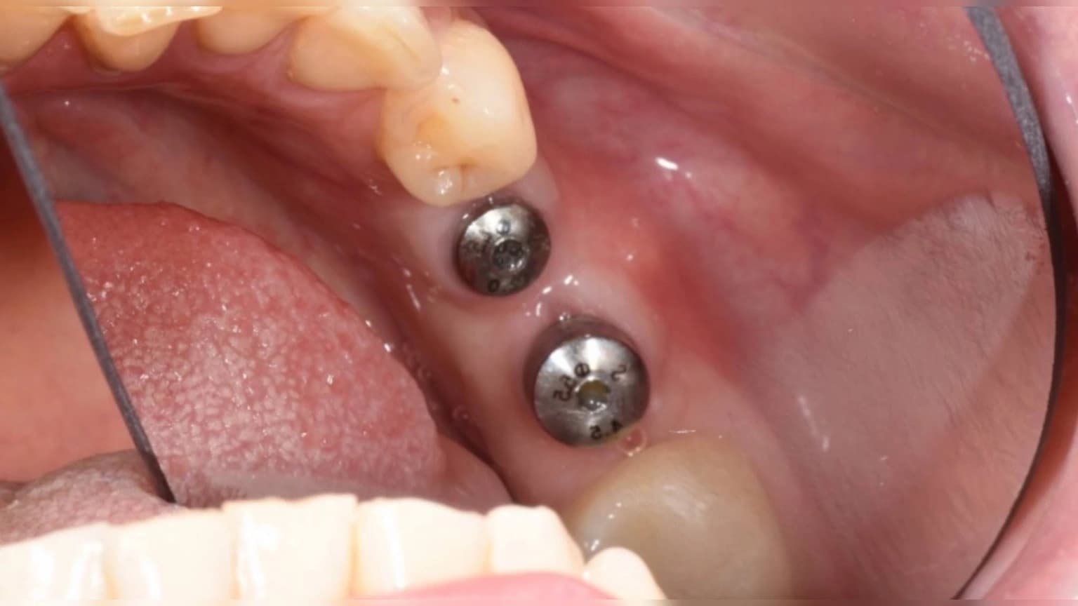 Імплантація