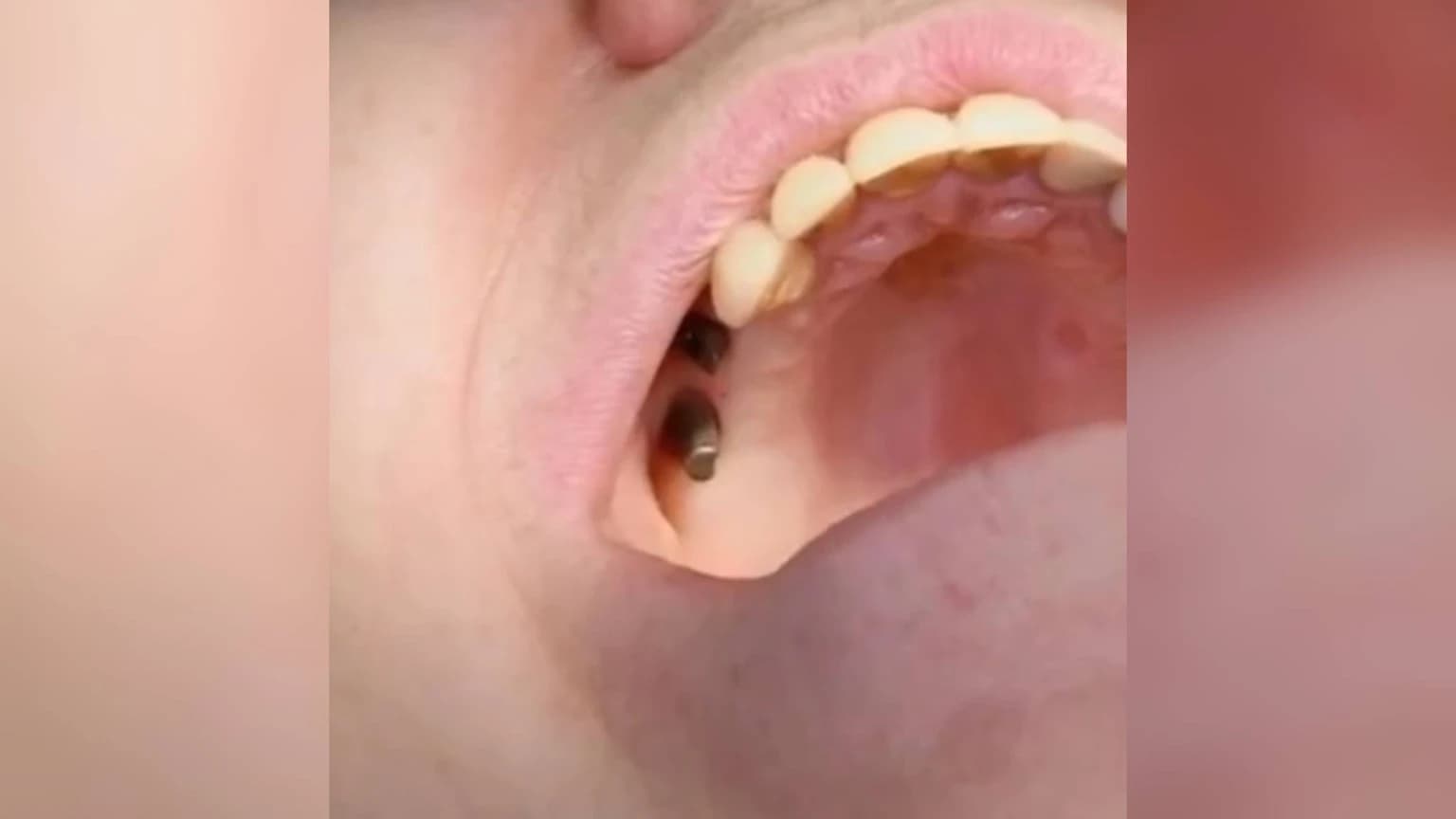 До лікування