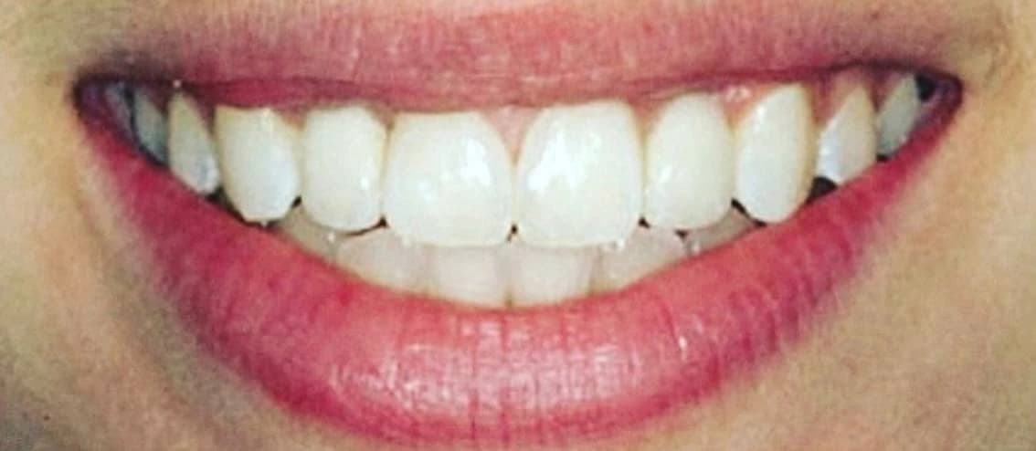 Результат одноетапної імплантації