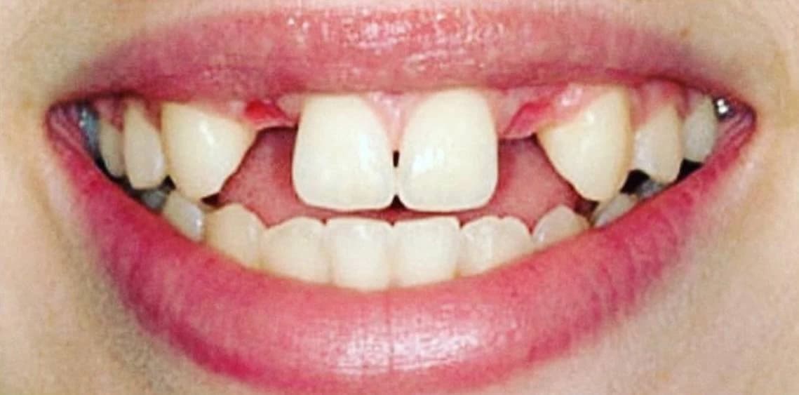 Зуб до одноетапної імплантації