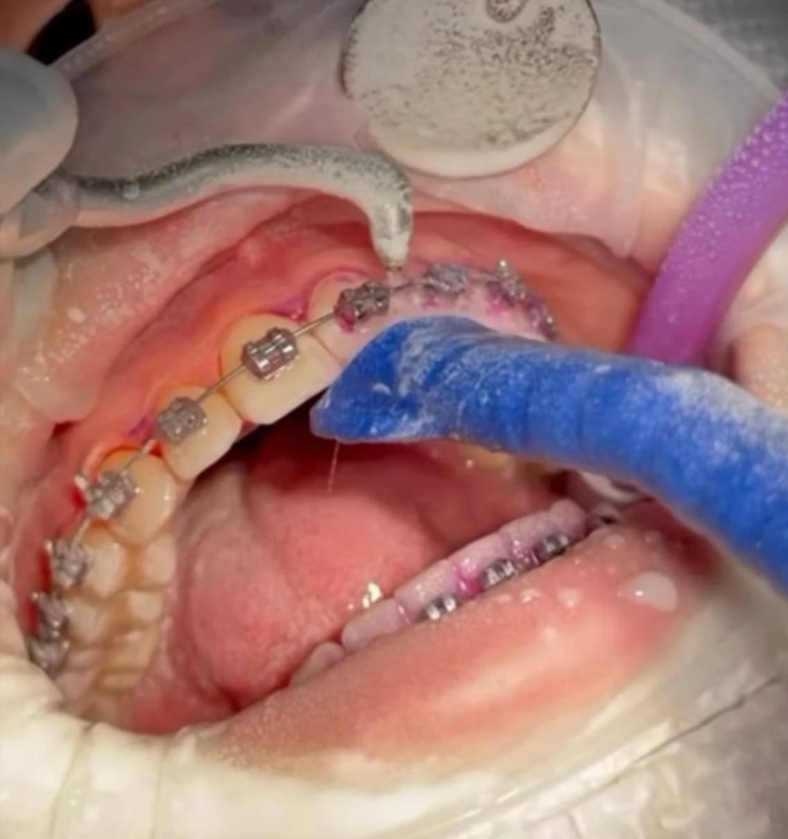 Чистка AirFlow навколо брекетів для видалення нальоту